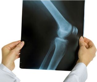 X-ray of knee arthrosis